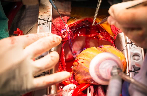 Coronary artery bypass grafting obtuse marginal artery anastomosis