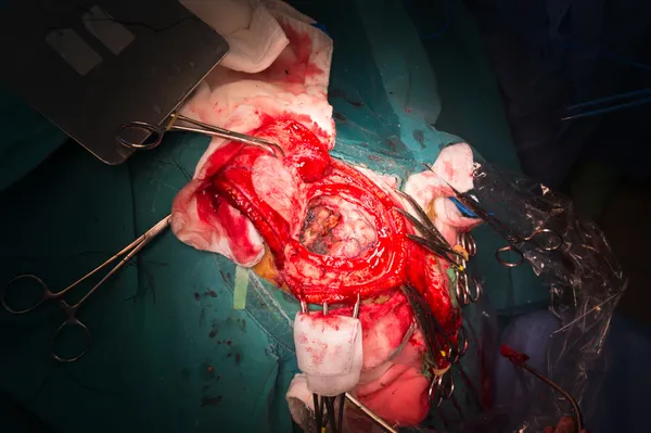 Craniectomy in case of brain tumor at frontal lobe