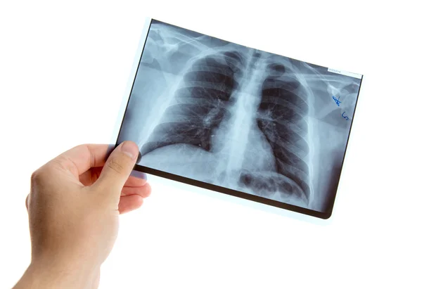 Hand holding lung radiography — Stock Photo, Image