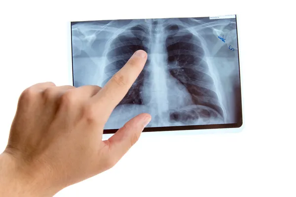 폐암 방사선에 가리키는 손 — 스톡 사진