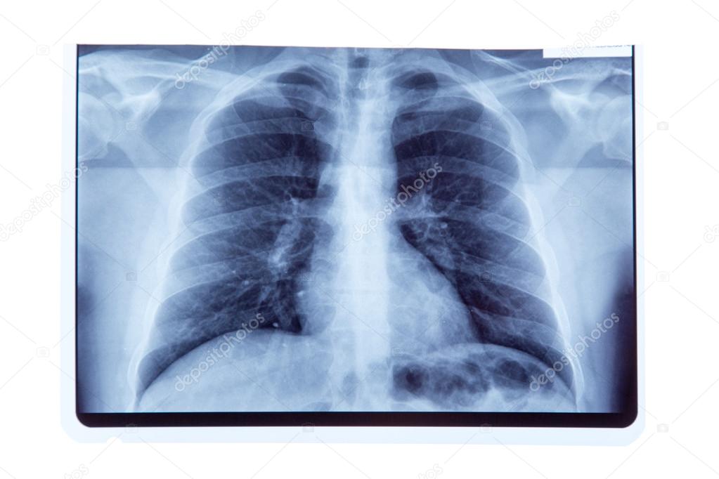 Lung radiography x-ray