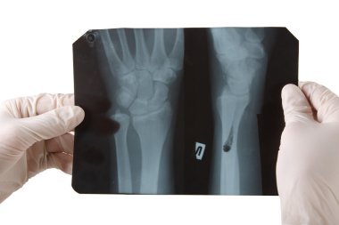 Ellerin Xray görüntü