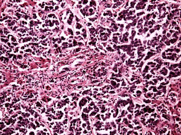 Liver cancer of a human — Stock Photo, Image