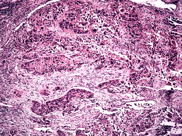 Carcinoma polmonare centrale di un essere umano — Foto Stock