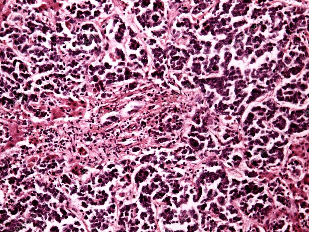 Liver cancer of a human