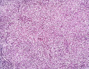 bir insan karaciğer yağlı hepatosis