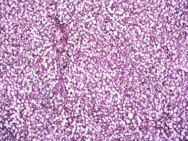 bir insan karaciğer yağlı hepatosis