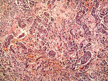 hepatosellüler kanser karaciğer bir insan