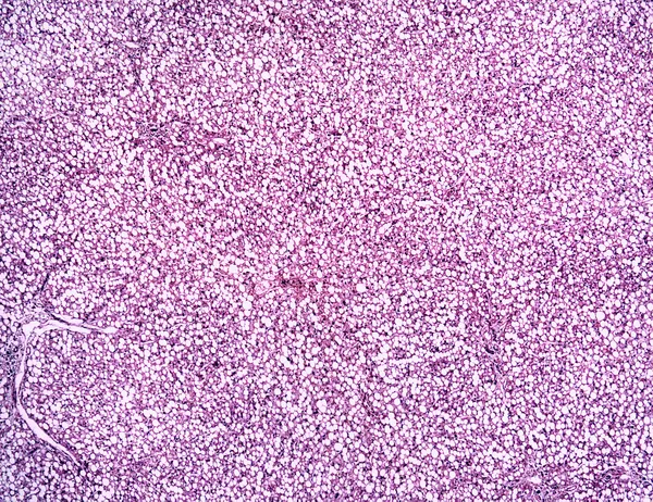 bir insan karaciğer yağlı hepatosis