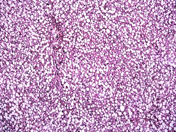 人間の肝臓の脂肪酸 hepatosis — ストック写真