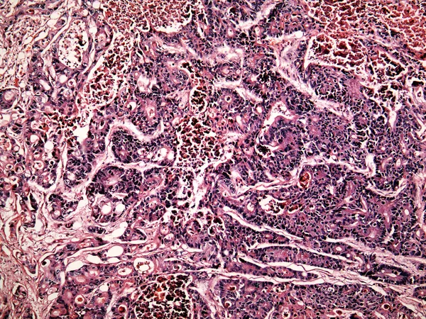 Рак печени человека — стоковое фото