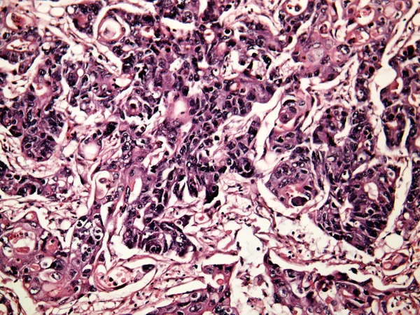 Cancro do fígado de um ser humano — Fotografia de Stock