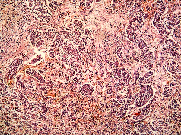 Hepatocellulär cancer i levern av en mänsklig — Stockfoto