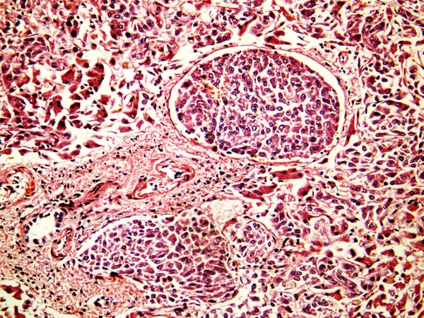 Hepatocellulär cancer i levern av en mänsklig — Stockfoto