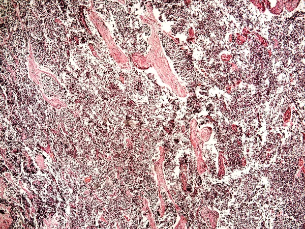 Small-cell lung cancer of a human — Stock Photo, Image