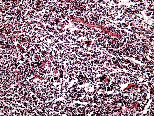 Carcinoma polmonare a piccole cellule di un essere umano — Foto Stock