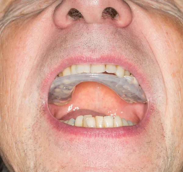 Närbild på tänder vakt i senior mun — Stockfoto