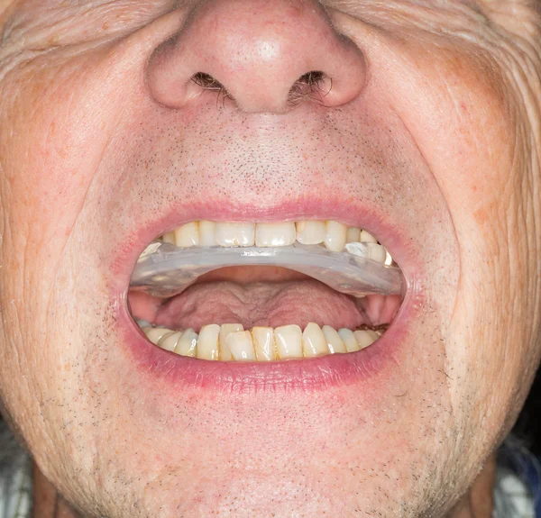 Primo piano della protezione dei denti nella bocca dell'anziano — Foto Stock