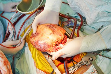 Cardiac surgery heart transplantation clipart