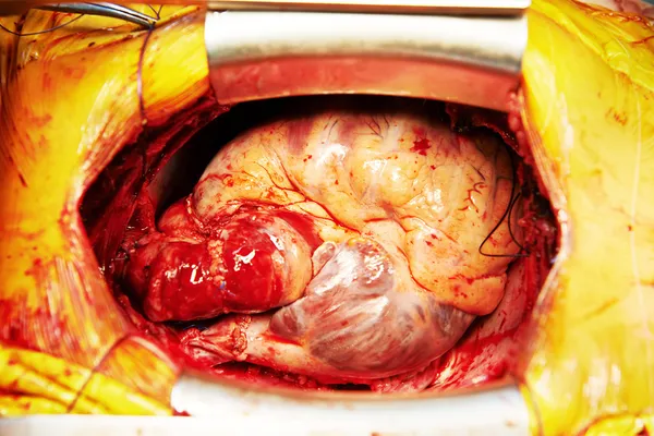 Cardiac surgery heart transplantation — Stock Photo, Image