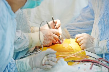Surgeons team at cardiac surgery operation clipart