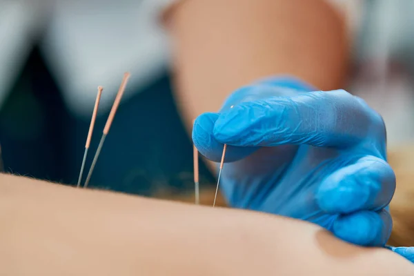 Akupunktur medizinische Behandlung. Alternative Medizin — Stockfoto