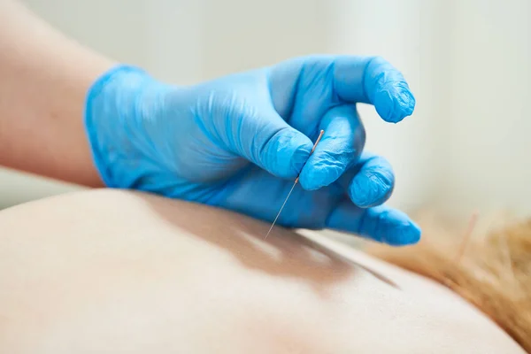 Traitement Médical Acupuncture Médecins Mains Dans Des Gants Avec Des — Photo