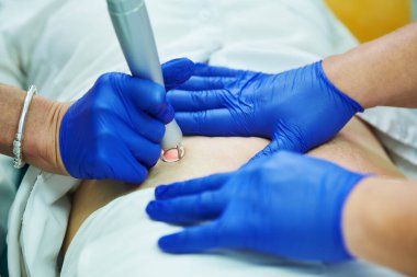 Lazer estetik kozmetik dermatoloji. Karbondioksit karbondioksit lazeriyle yara izinin revizyonu ve tedavisi.