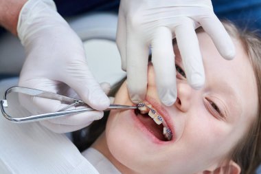 Diş teli kurulumu ve bakımı. Dişçi muayenesindeki küçük kız..