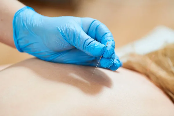 Akupunkturbehandlung Ärzte Legen Handschuhe Mit Speziellen Nadeln Eine Therapie Zur — Stockfoto