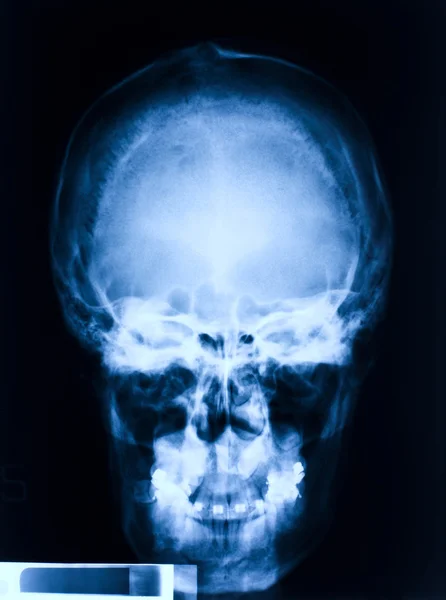 Skull x-ray — Stock Photo, Image