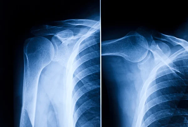 Shoulder x-ray — Stock Photo, Image