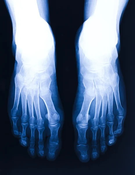 Radiografia del piede — Foto Stock