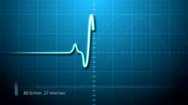 -EKG'sini Elektrokardiyogram