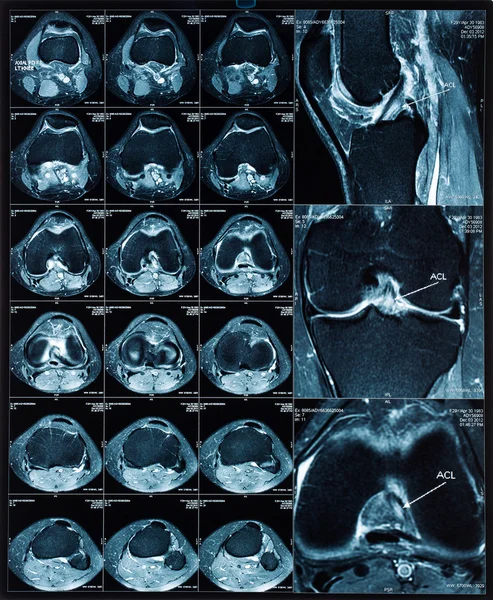 Imágenes MRT de rodilla — Foto de Stock