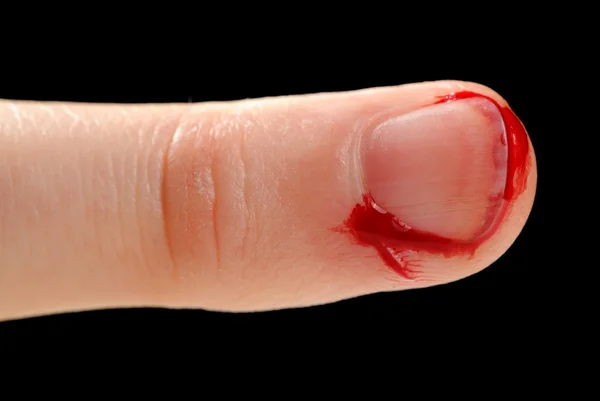 Bleeding from Cut Finger — Stock Photo, Image