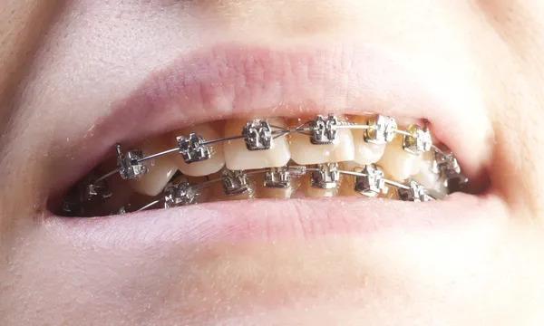 Girl smiling with braces — Stock Photo, Image