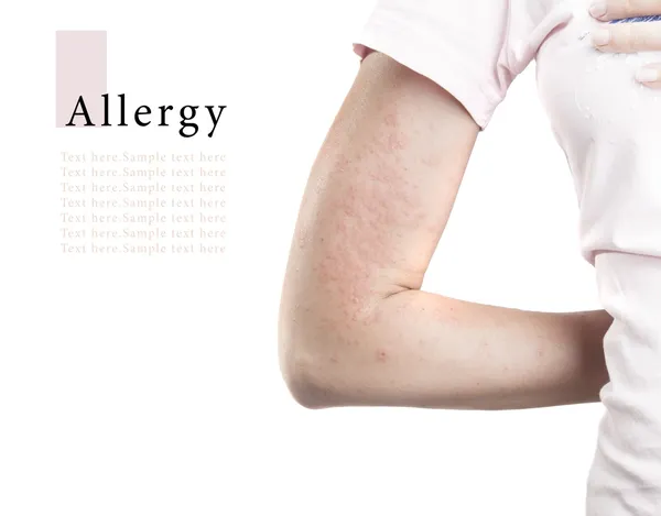 Mujer con alergia —  Fotos de Stock