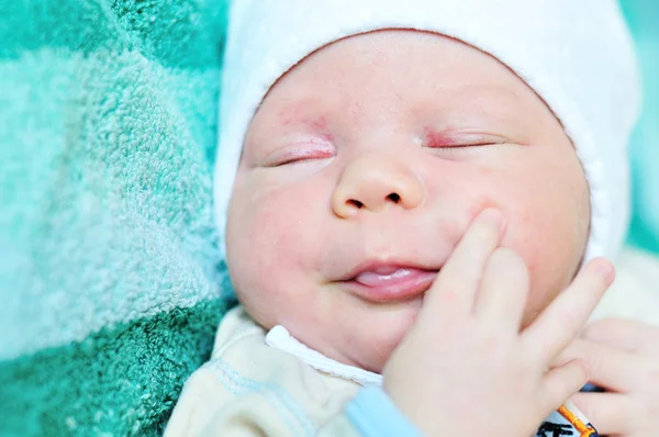 新生児にきび — ストック写真