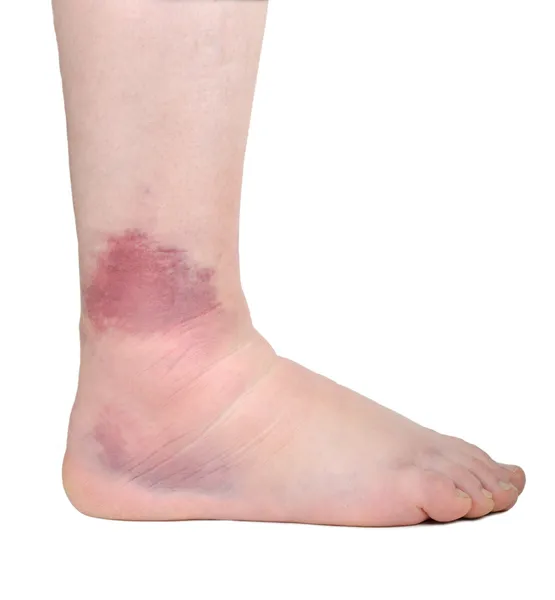 27 170 Imagens De Entorse Entorse Fotografias De Stock Depositphotos