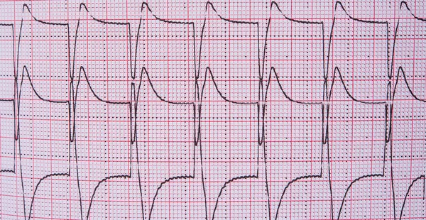 Eletrocardiograma do coração — Fotografia de Stock