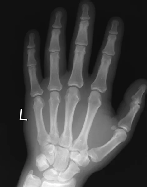 X-ray van menselijke hand — Stockfoto