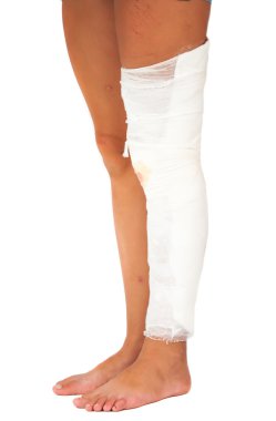 bacaklar, ve bunlardan biri bir bandaj ile bandaja alınmıştı