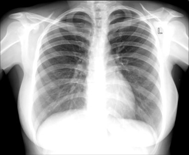 x-ray görüntü göğüs