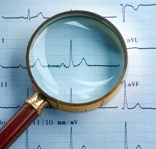 Magnifier on cardiogram — Stock Photo, Image