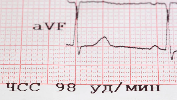 Cardiogram — Stockfoto