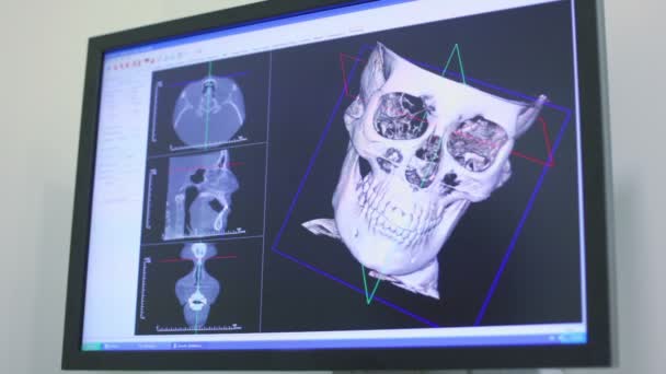 Ultrasound image of skull rotates on screen closeup — Stock Video