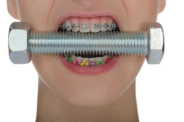 Dentes com braçadeiras parafuso de metal comprimido — Fotografia de Stock