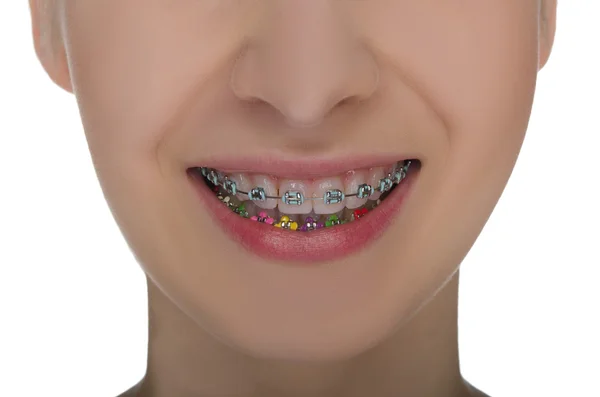 Primer plano de la boca sonriente con frenos en los dientes — Foto de Stock