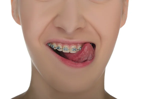 Primer plano de la boca sonriente con frenos — Foto de Stock